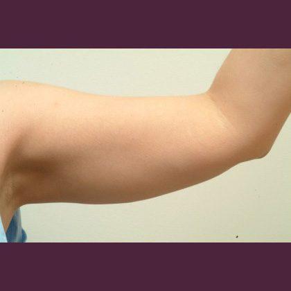 Liposuction before at Cosmetic Surgery Associates in Bethesda, MD