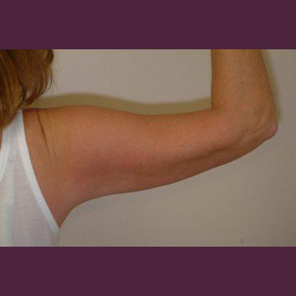 Cosmetic Surgery Associates after — Bethesda, MD