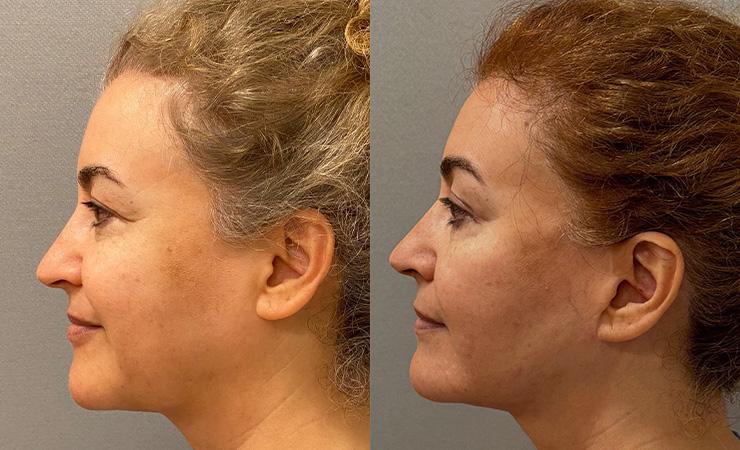 Cosmetic Surgery Associates buccal fat result — Bethesda, MD
