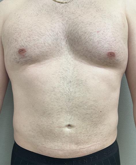 Liposuction after at Cosmetic Surgery Associates in Bethesda, MD