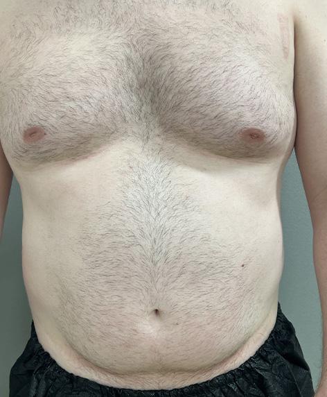 Liposuction before at Cosmetic Surgery Associates in Bethesda, MD