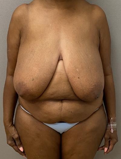 Breast Reduction before at Cosmetic Surgery Associates in Bethesda, MD