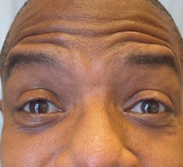 Botox before at Cosmetic Surgery Associates in Bethesda, MD