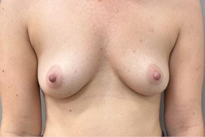Fat Transfer Breast Augmentation before at Cosmetic Surgery Associates in Bethesda, MD