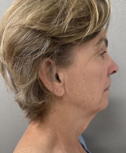 Facelift before at Cosmetic Surgery Associates in Bethesda, MD