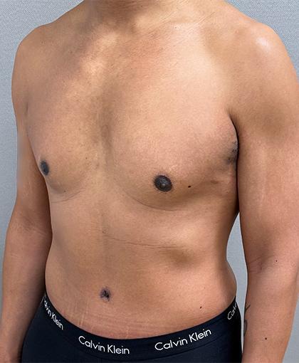 Mini Tummy Tuck after at Cosmetic Surgery Associates in Bethesda, MD