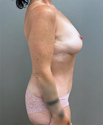 Cosmetic Surgery Associates mommy makeover after — Bethesda, MD