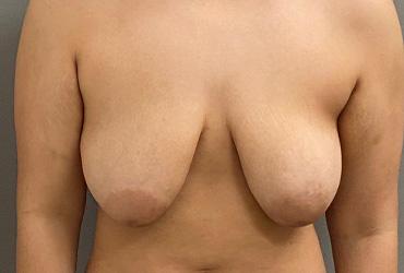 Breast Lift before at Cosmetic Surgery Associates in Bethesda, MD