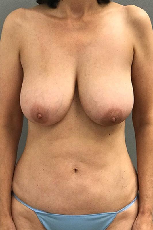 Breast Reduction before at Cosmetic Surgery Associates in Bethesda, MD