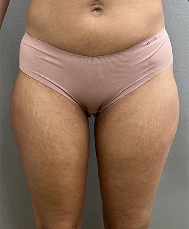 Liposuction after at Cosmetic Surgery Associates in Bethesda, MD
