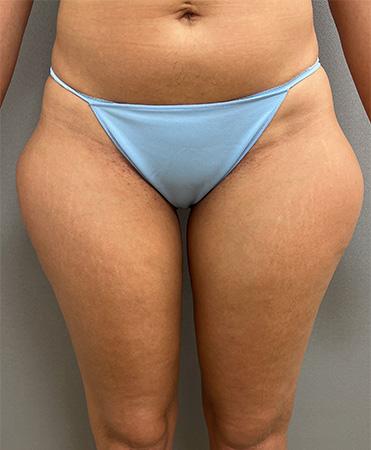 Liposuction before at Cosmetic Surgery Associates in Bethesda, MD