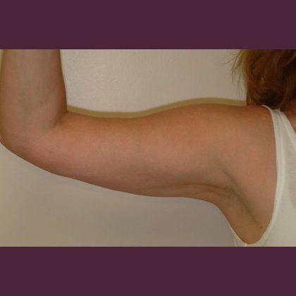 Cosmetic Surgery Associates after — Bethesda, MD
