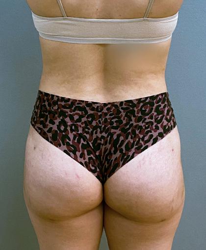 Brazilian Butt Lift after at Cosmetic Surgery Associates in Bethesda, MD