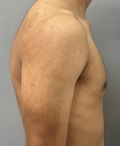 Cosmetic Surgery Associates gynecomastia after — Bethesda, MD