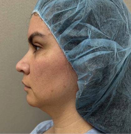 Neck Liposuction before at Cosmetic Surgery Associates in Bethesda, MD