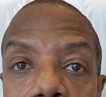 Botox after at Cosmetic Surgery Associates in Bethesda, MD