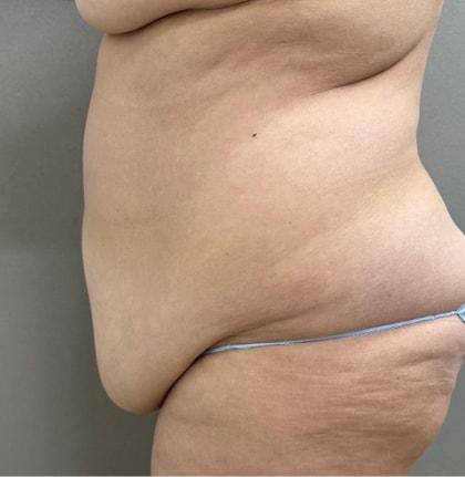 Mini Tummy Tuck before at Cosmetic Surgery Associates in Bethesda, MD