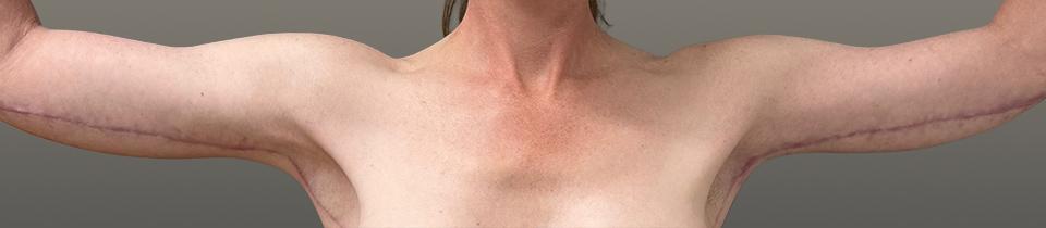 Cosmetic Surgery Associates arm lift after — Bethesda, MD