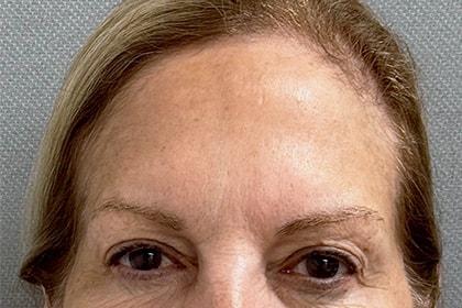 Brow Lift before at Cosmetic Surgery Associates in Bethesda, MD