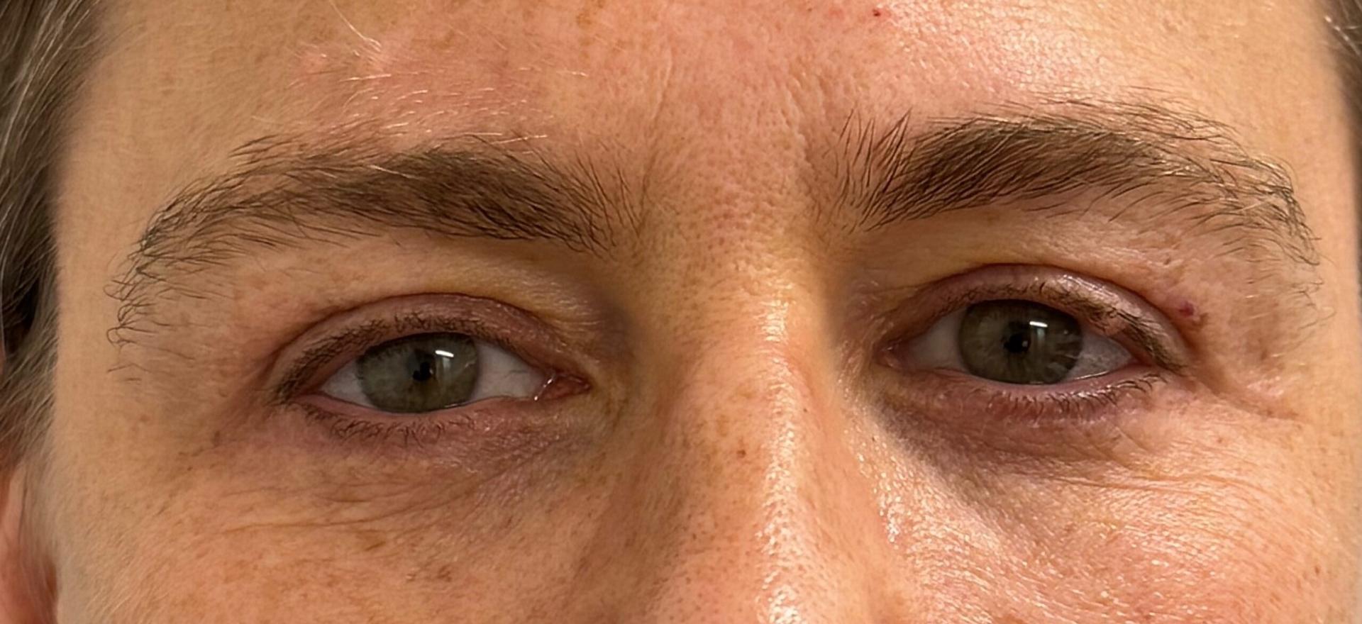 Cosmetic Surgery Associates eyelid lift after — Bethesda, MD