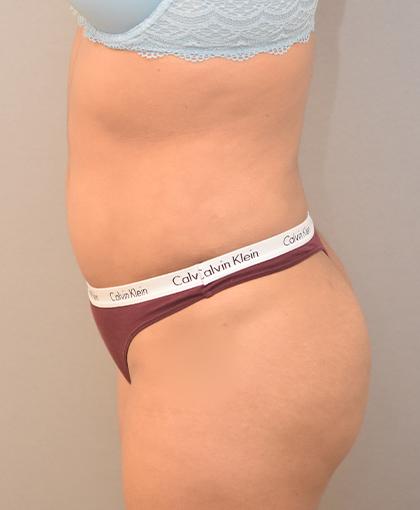 Brazilian Butt Lift after at Cosmetic Surgery Associates in Bethesda, MD