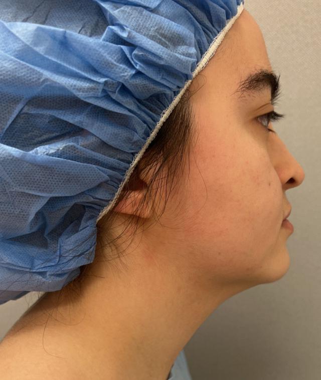 Brazilian Butt Lift before at Cosmetic Surgery Associates in Bethesda, MD