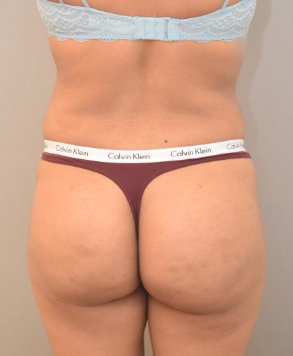 Brazilian Butt Lift after at Cosmetic Surgery Associates in Bethesda, MD
