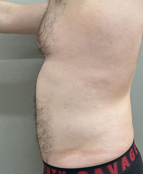 Liposuction after at Cosmetic Surgery Associates in Bethesda, MD