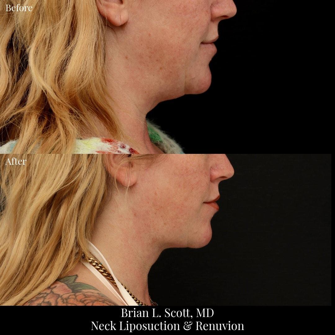 NewSkin MedSpa & Plastic Surgery neck liposuction result — Bellevue, WA