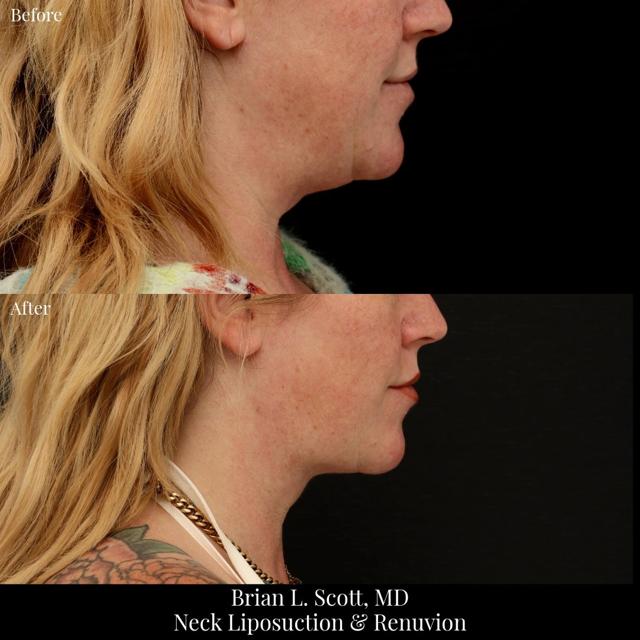 Neck Liposuction result at NewSkin MedSpa & Plastic Surgery in Bellevue, WA