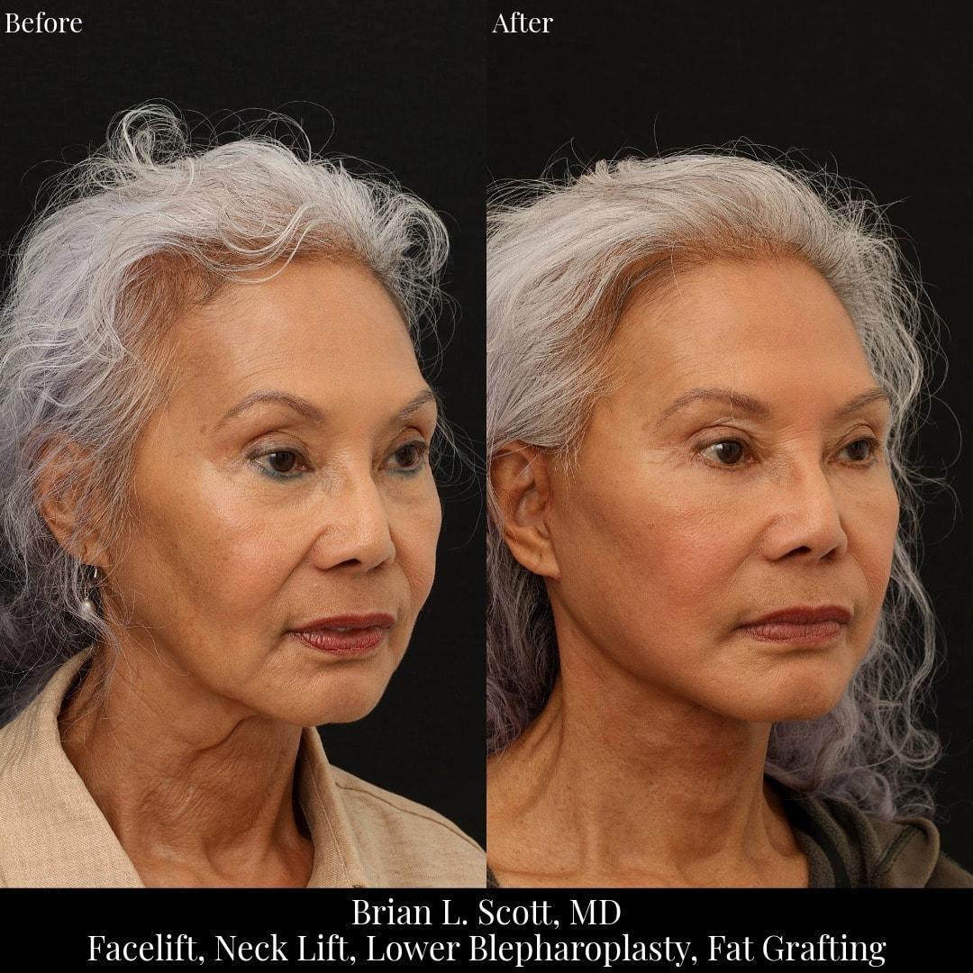 NewSkin MedSpa & Plastic Surgery facelift result — Bellevue, WA