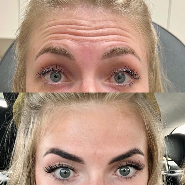 Botox result at NewSkin MedSpa & Plastic Surgery in Bellevue, WA