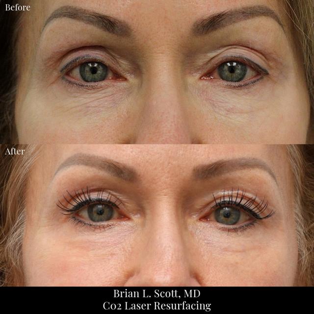 Laser Skin Resurfacing result at NewSkin MedSpa & Plastic Surgery in Bellevue, WA