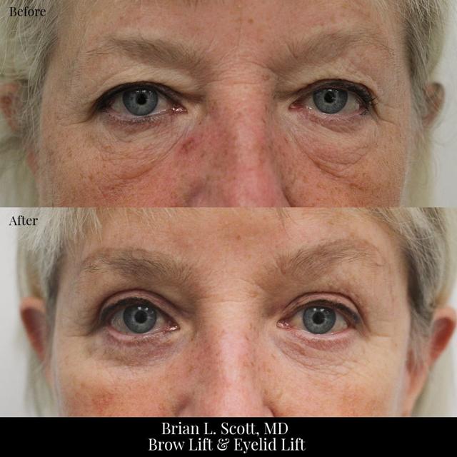 Brow Lift result at NewSkin MedSpa & Plastic Surgery in Bellevue, WA
