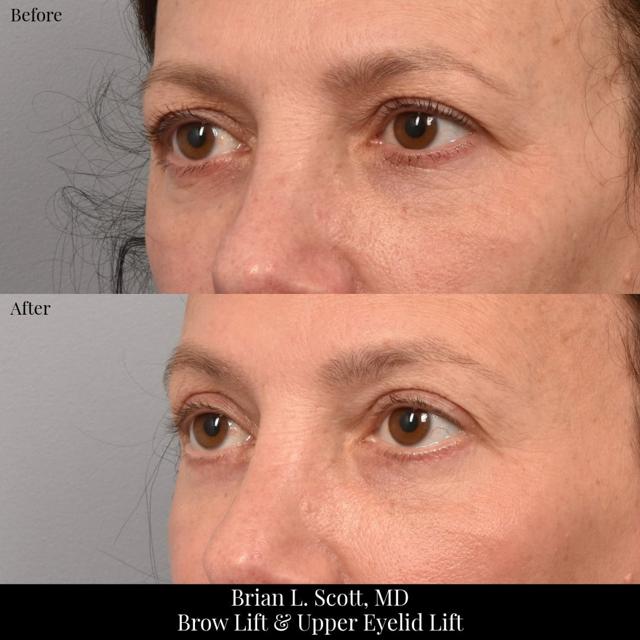 Brow Lift result at NewSkin MedSpa & Plastic Surgery in Bellevue, WA