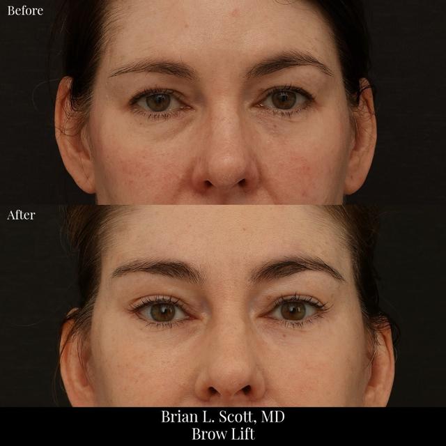 Brow Lift result at NewSkin MedSpa & Plastic Surgery in Bellevue, WA