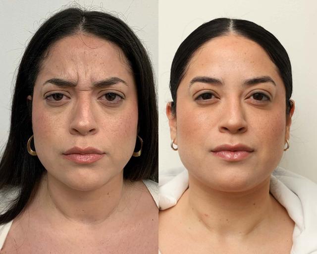 Botox result at NewSkin MedSpa & Plastic Surgery in Bellevue, WA