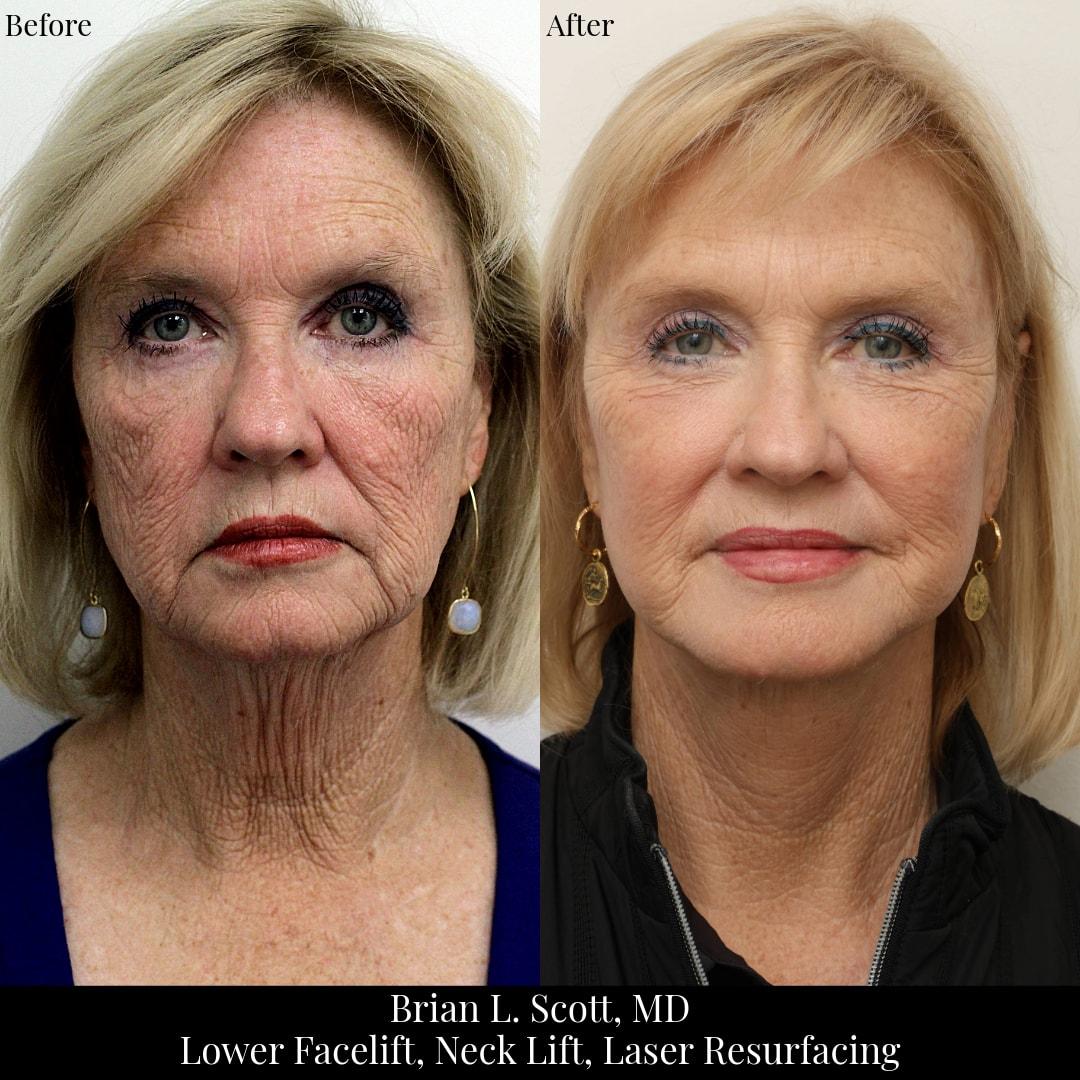 NewSkin MedSpa & Plastic Surgery facelift result — Bellevue, WA
