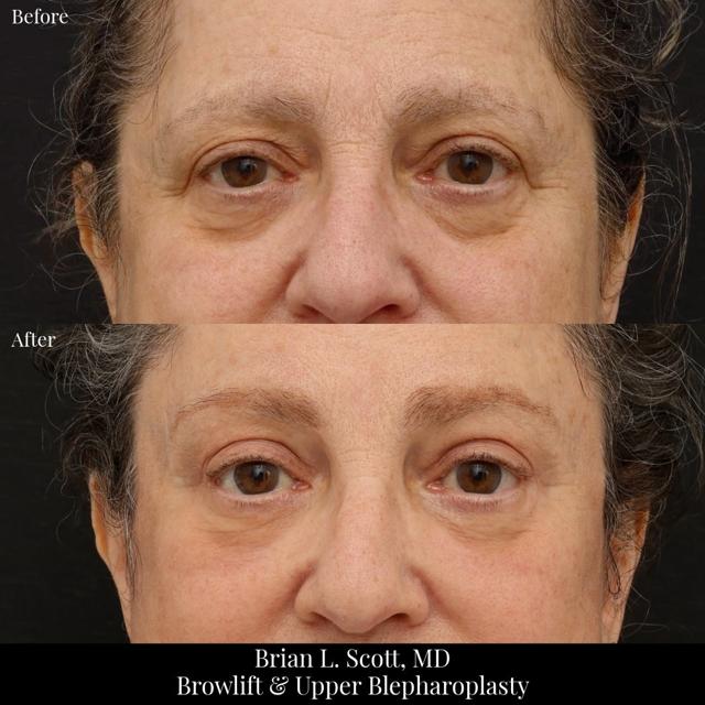 Brow Lift result at NewSkin MedSpa & Plastic Surgery in Bellevue, WA