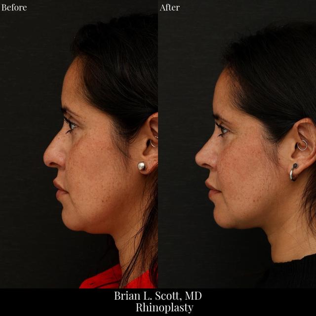 Rhinoplasty result at NewSkin MedSpa & Plastic Surgery in Bellevue, WA