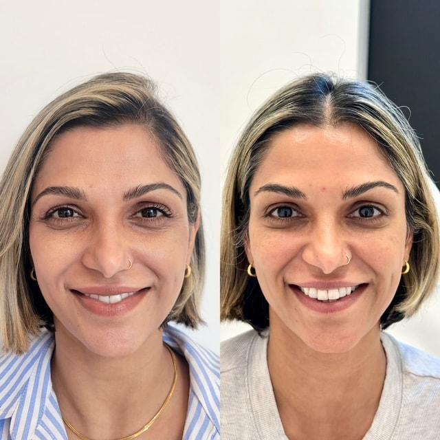 Botox result at NewSkin MedSpa & Plastic Surgery in Bellevue, WA