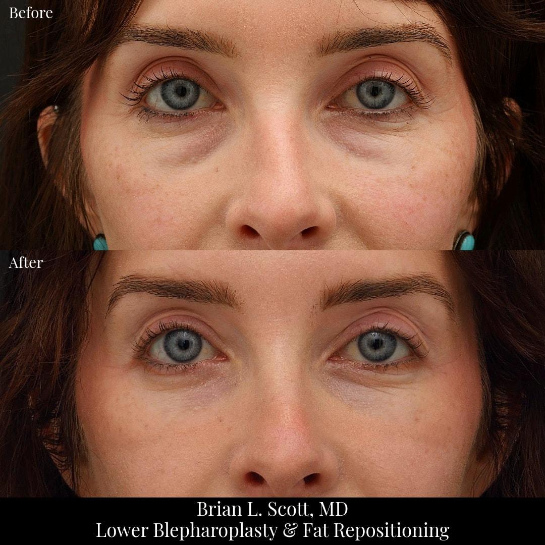 NewSkin MedSpa & Plastic Surgery eyelid lift result — Bellevue, WA