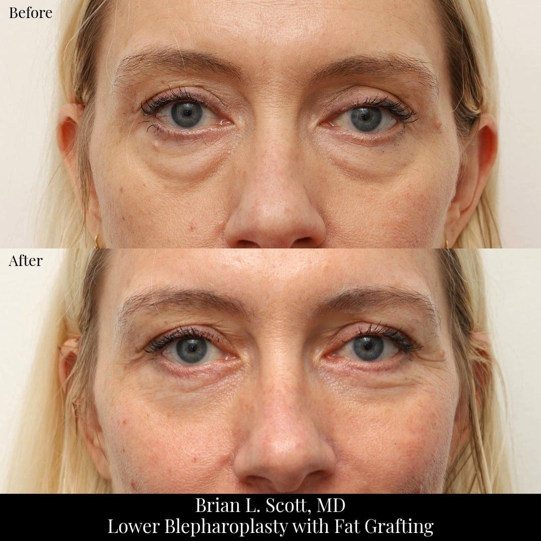 NewSkin MedSpa & Plastic Surgery eyelid lift result — Bellevue, WA