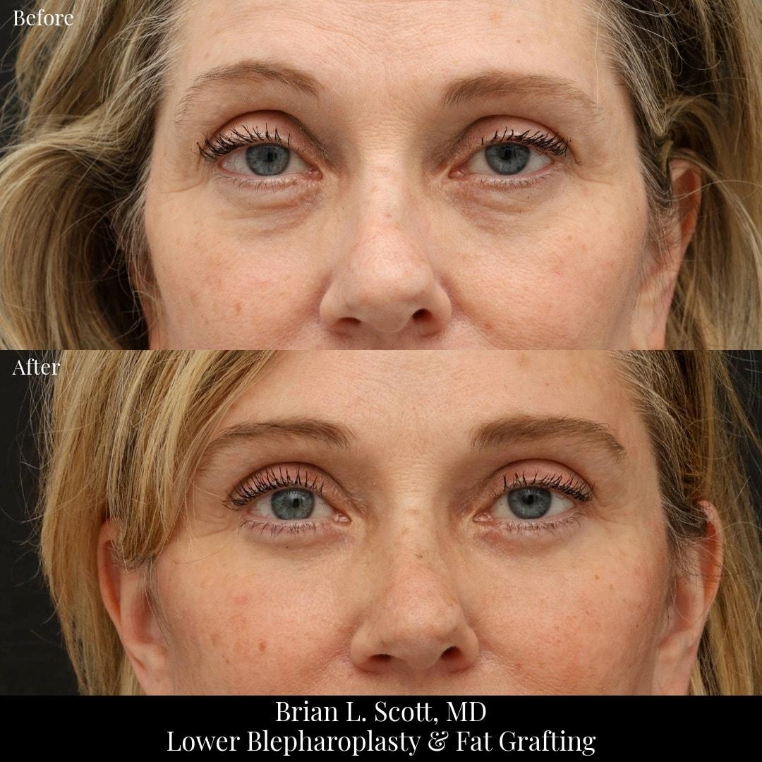 NewSkin MedSpa & Plastic Surgery eyelid lift result — Bellevue, WA