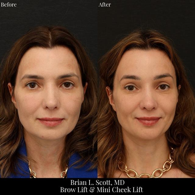 Brow Lift result at NewSkin MedSpa & Plastic Surgery in Bellevue, WA