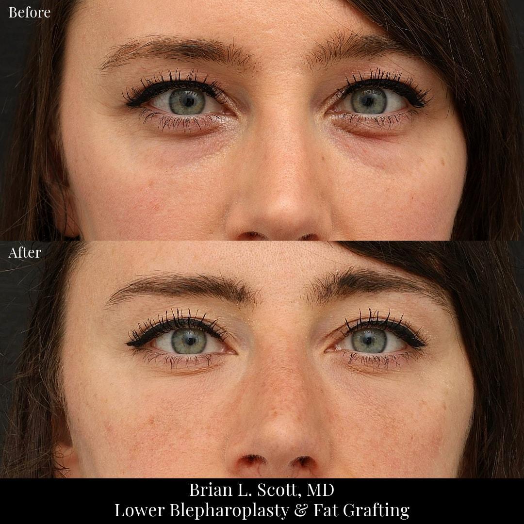 NewSkin MedSpa & Plastic Surgery eyelid lift result — Bellevue, WA