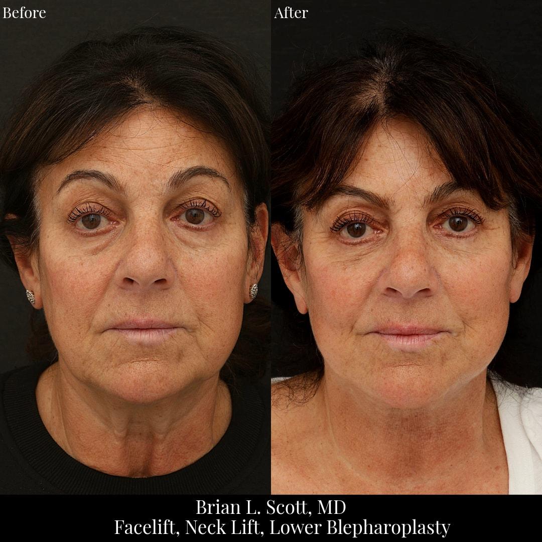 NewSkin MedSpa & Plastic Surgery facelift result — Bellevue, WA