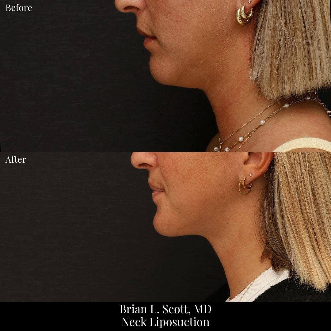 NewSkin MedSpa & Plastic Surgery neck liposuction result — Bellevue, WA
