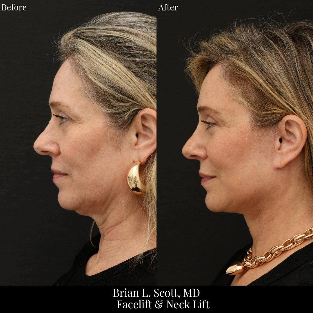 NewSkin MedSpa & Plastic Surgery facelift result — Bellevue, WA
