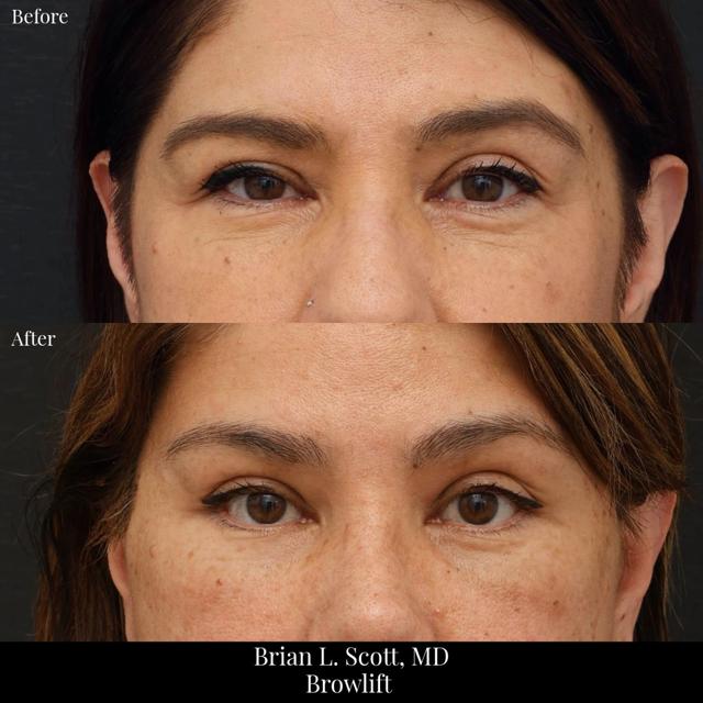 Brow Lift result at NewSkin MedSpa & Plastic Surgery in Bellevue, WA